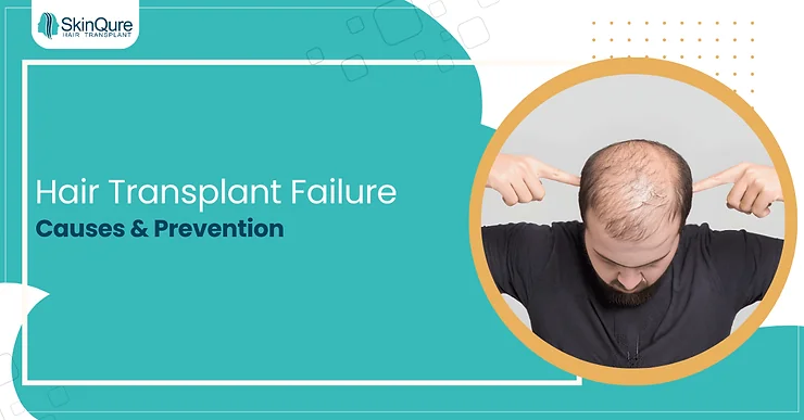 Hair Transplant Failure: Causes & Prevention - SkinQure, Delhi