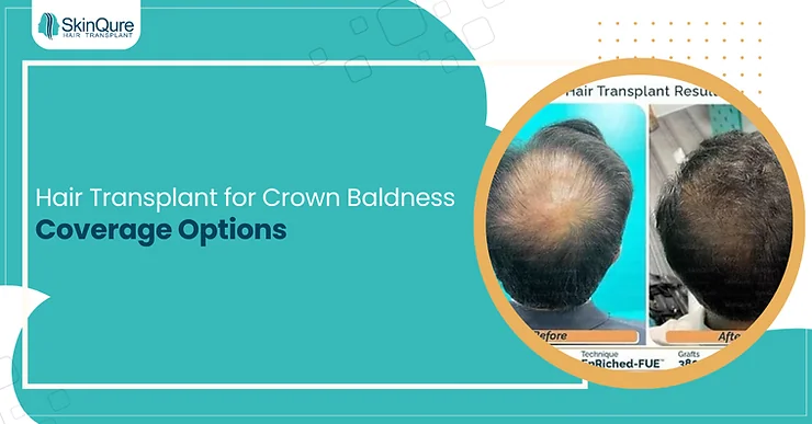Hair Transplant for Crown Baldness Coverage Options - SkinQure, Delhi