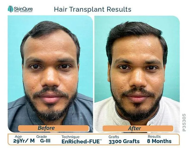 Hair Transplant for Receding Hairline Early Stage Guide - SkinQure, Delhi