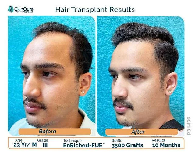 Hair Transplant for Receding Hairline Early Stage Guide - SkinQure, Delhi