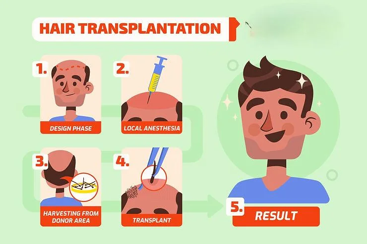 Hair transplant in Delhi: complete beginner’s guide 2026 - SkinQure, Delhi