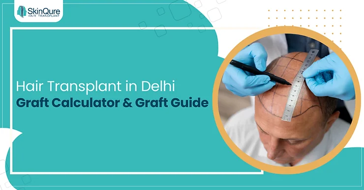 Hair Transplant in Delhi: Graft Calculator & Graft Guide - SkinQure, Delhi