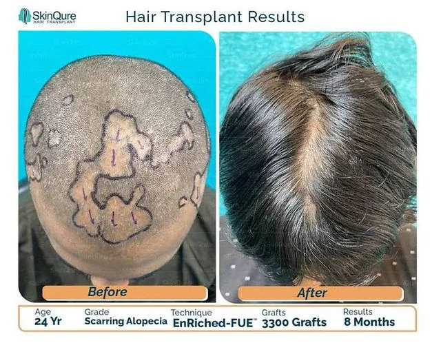 Hair Transplant in Scarring Alopecia: Who Is the Ideal Candidate? - SkinQure, Delhi