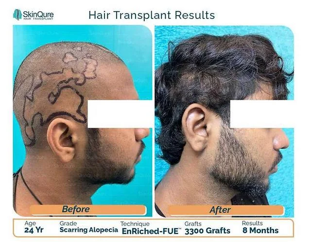 Hair Transplant in Scarring Alopecia: Who Is the Ideal Candidate? - SkinQure, Delhi