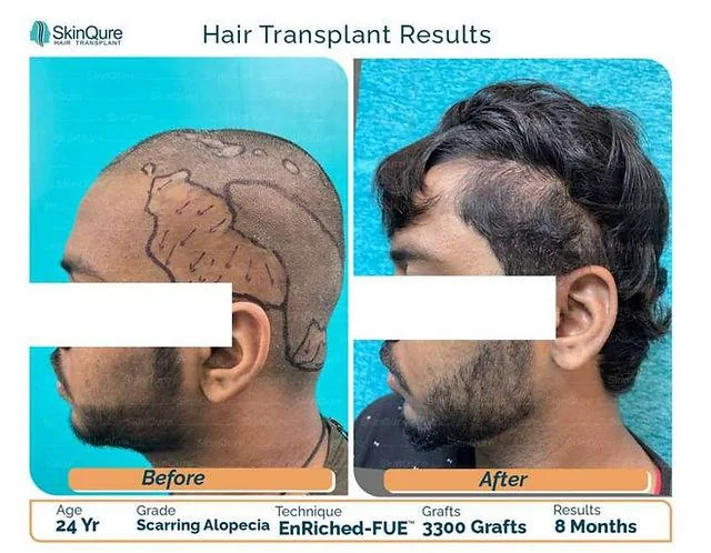 Hair Transplant in Scarring Alopecia: Who Is the Ideal Candidate? - SkinQure, Delhi