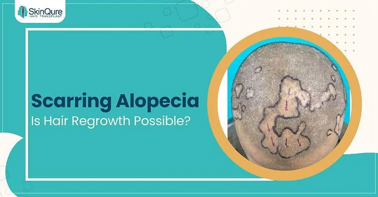 Hair Transplant in Scarring Alopecia: Who Is the Ideal Candidate? - SkinQure, Delhi