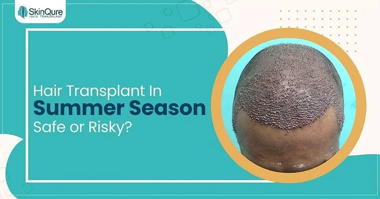 Is it a Good Time for Hair Transplant in Summer? - SkinQure, Delhi