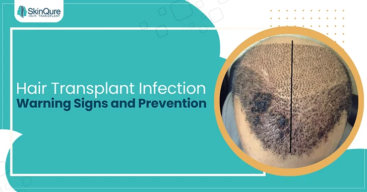 Hair Transplant Infection: Warning Signs and Prevention - SkinQure, Delhi