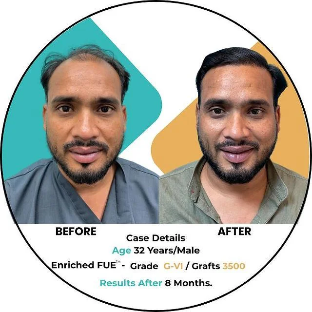 Hair Transplant Results Delhi: Before After Expectations - SkinQure, Delhi