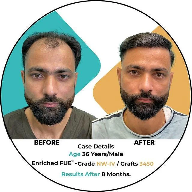 Unveiling the Link: Does Smoking Cause Hair Loss? - SkinQure, Delhi