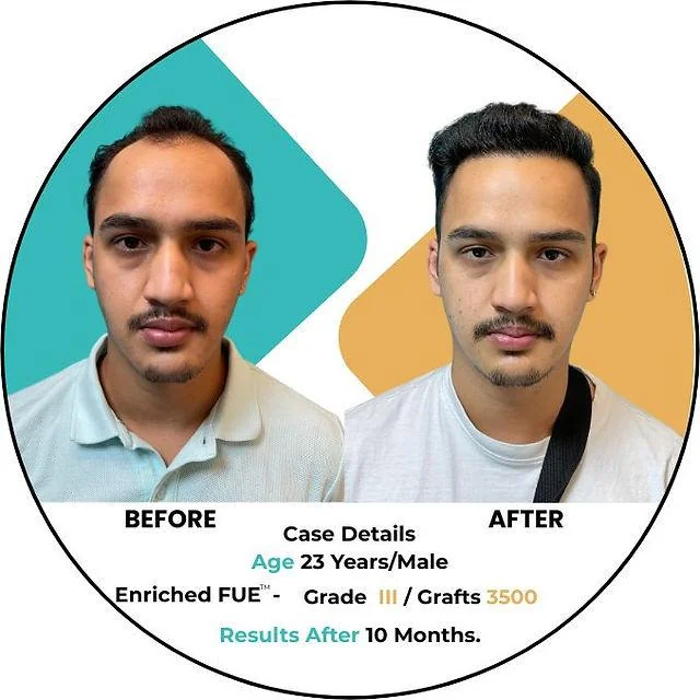 Hair Transplant Age Limit: When Is Too Young or Too Old? - SkinQure, Delhi