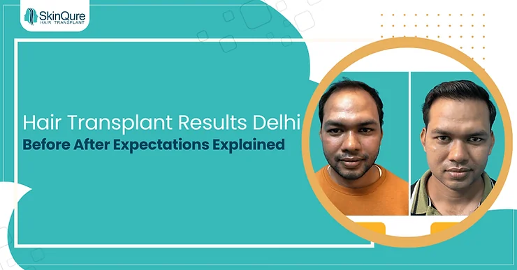 Hair Transplant Results Delhi: Before After Expectations - SkinQure, Delhi