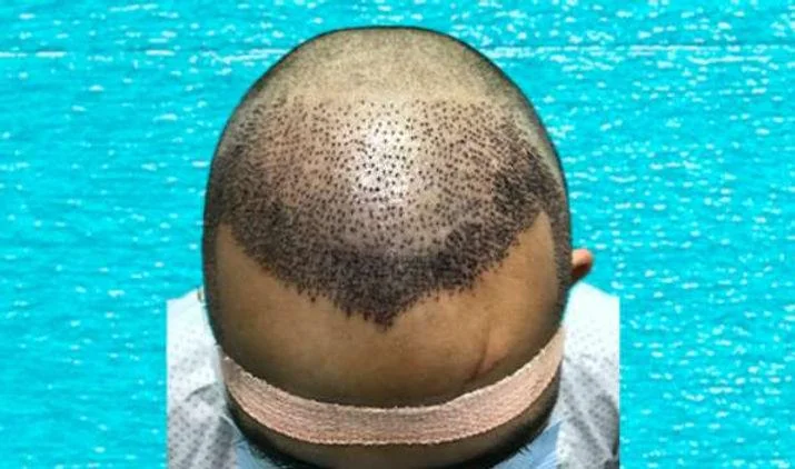 Hair Transplant Results Explained: A Simple Guide - SkinQure, Delhi