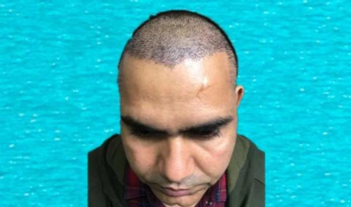 Hair Transplant Results Explained: A Simple Guide - SkinQure, Delhi