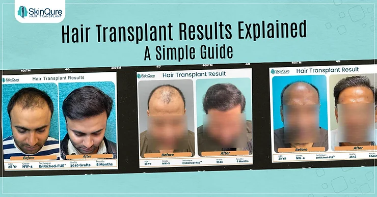 Hair Transplant Results Explained: A Simple Guide - SkinQure, Delhi