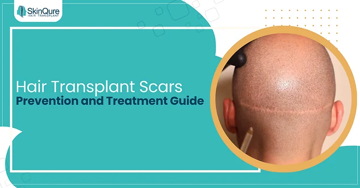 Hair Transplant Scars: Prevention and Treatment Guide - SkinQure, Delhi