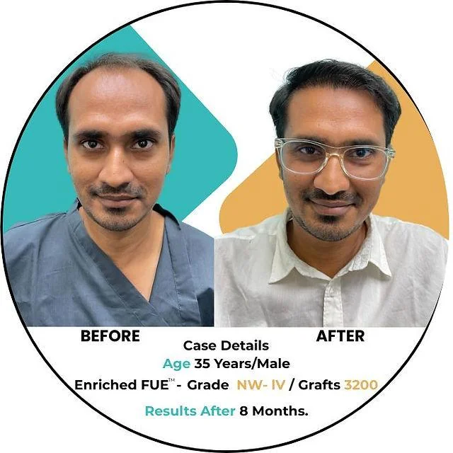 Hair Transplant Success Rate: Delhi's Best Statistics - SkinQure, Delhi
