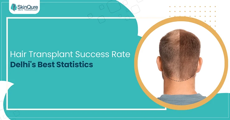 Hair Transplant Success Rate: Delhi's Best Statistics - SkinQure, Delhi
