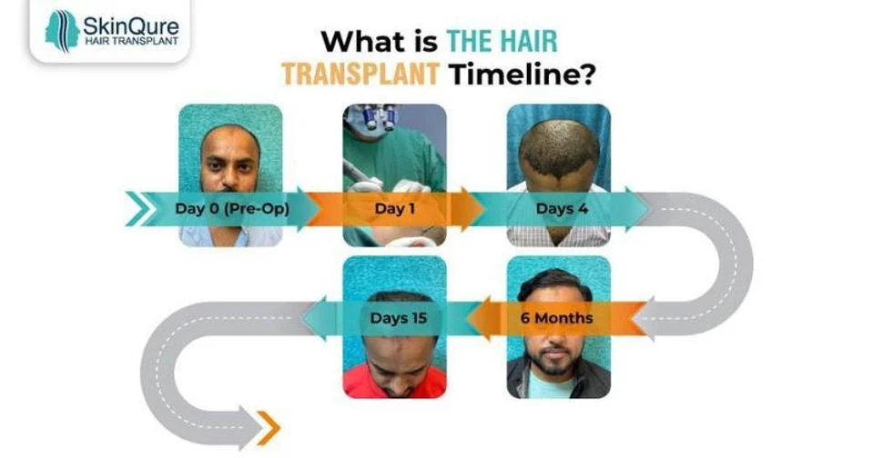What is the hair transplant timeline - SkinQure, Delhi