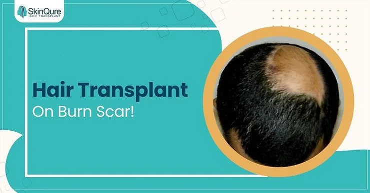 Hair Transplantation on Burn Scars in India? - SkinQure, Delhi