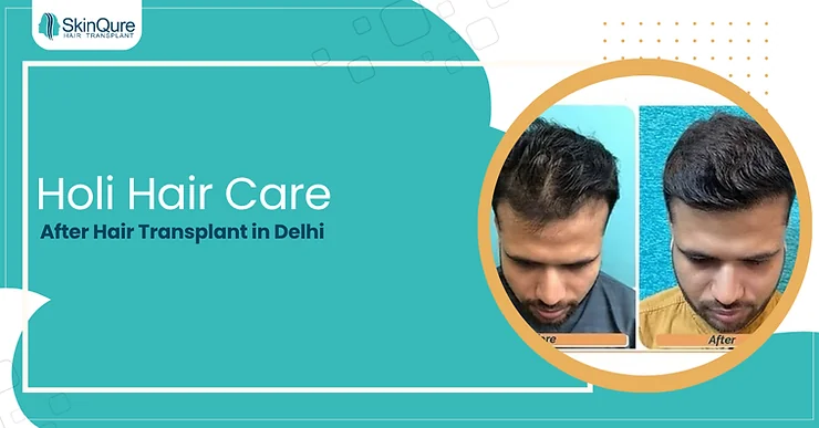 Holi Hair Care After Hair Transplant in Delhi - SkinQure, Delhi
