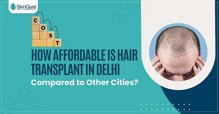 How Affordable is Hair Transplant in Delhi Compared to Other Cities? - SkinQure, Delhi