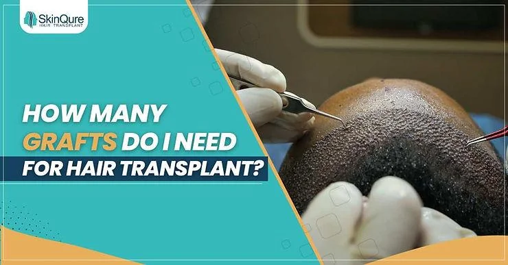 How Many Grafts Do I Need for Hair Transplant? - SkinQure, Delhi