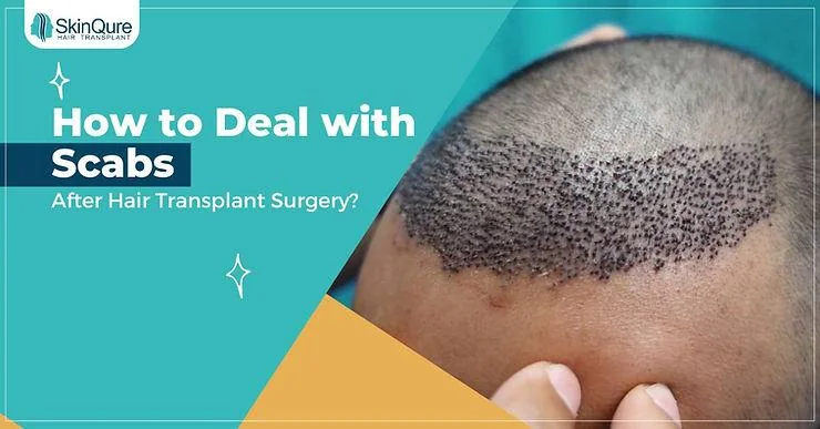 How to Deal with Scabs After Hair Transplant Surgery? - SkinQure, Delhi