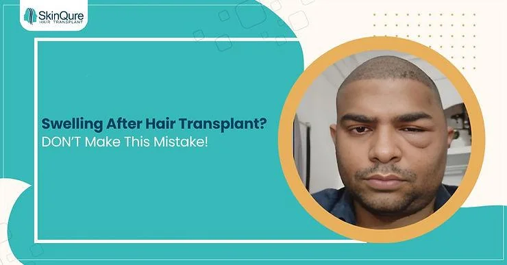 How to Deal with Swelling After a Hair Transplant - What to do? - SkinQure, Delhi