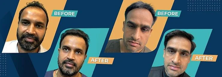 Itching After Hair Transplant: Why It Occurs & How to Get Rid of It - SkinQure, Delhi