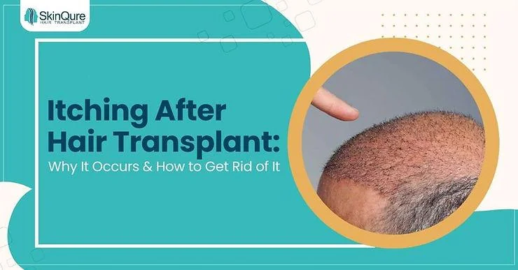 Itching After Hair Transplant: Why It Occurs & How to Get Rid of It - SkinQure, Delhi