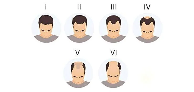 How to manage Grade 7 Baldness Effectively? - SkinQure, Delhi