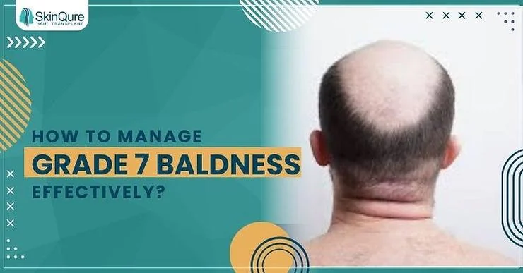 How to manage Grade 7 Baldness Effectively? - SkinQure, Delhi