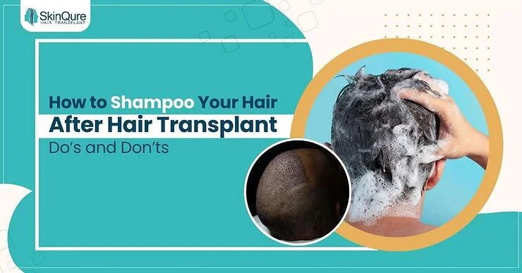 How to Shampoo Your Hair After a Hair Transplant: Do’s and Don’ts - SkinQure, Delhi