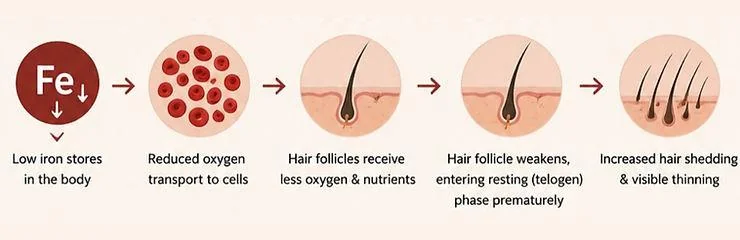 Iron Deficiency Hair Loss in Women: Signs & Fixes - SkinQure, Delhi