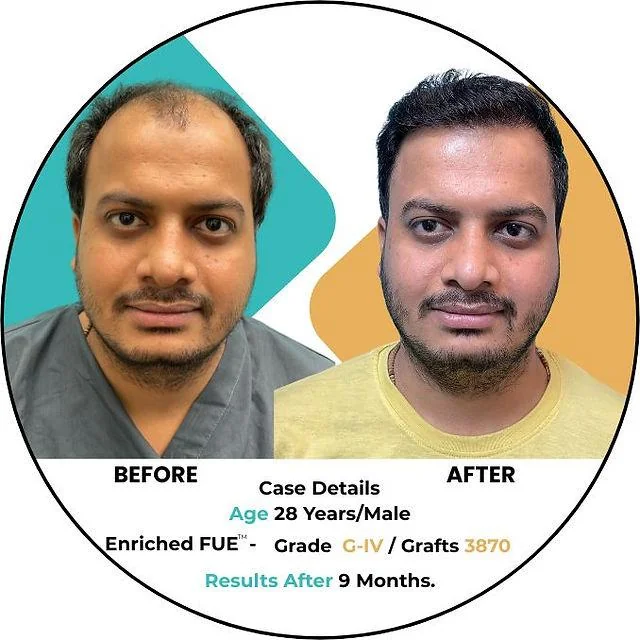Monsoon hair care essentials: A comprehensive guide to healthy hair - SkinQure, Delhi