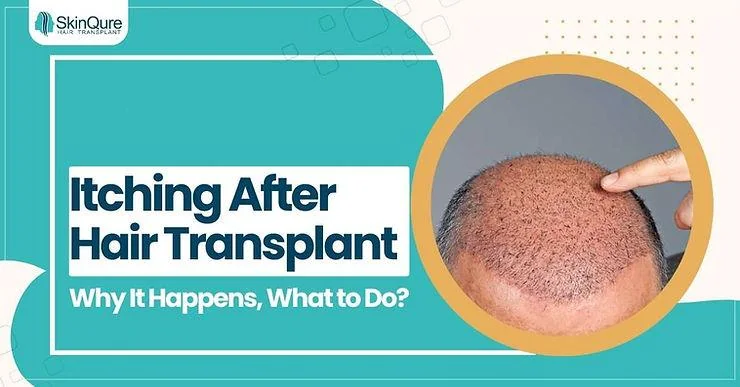 Itching After Hair Transplant: Why It Happens, What to Do? - SkinQure, Delhi