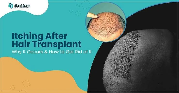 Itching After Hair Transplant: Why It Occurs & How to Get Rid of It - SkinQure, Delhi