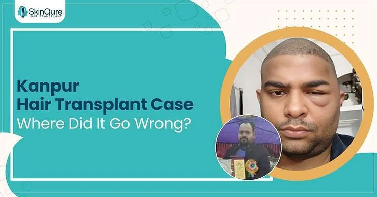 Kanpur Hair Transplant Case - Where Did It Go Wrong? - SkinQure, Delhi