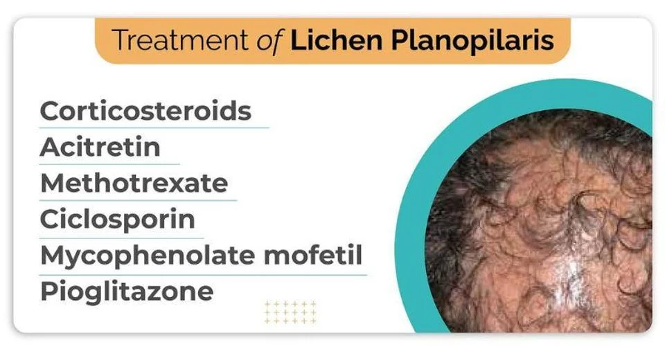 Treatment of lichen planopilaris - corticosteroids, acitretin, methotrexate, ciclosporin, mycophenolate mofetil, pioglitazone