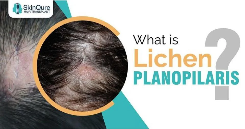 What is lichen planopilaris - scarring hair loss on the scalp - SkinQure, Delhi