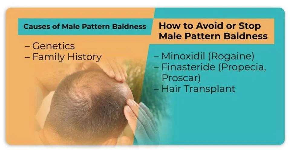 Causes of male pattern baldness - genetics and family history; how to avoid or stop it - minoxidil, finasteride, hair transplant