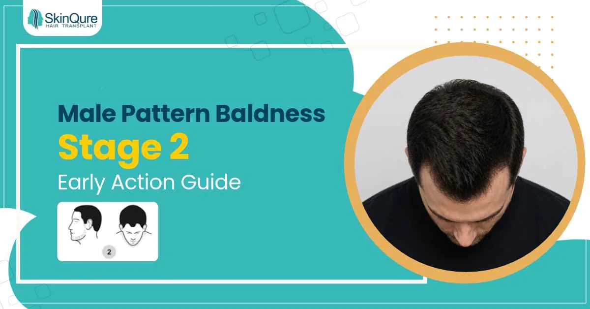Male Pattern Baldness Stage 2: Early Action Guide - SkinQure, Delhi