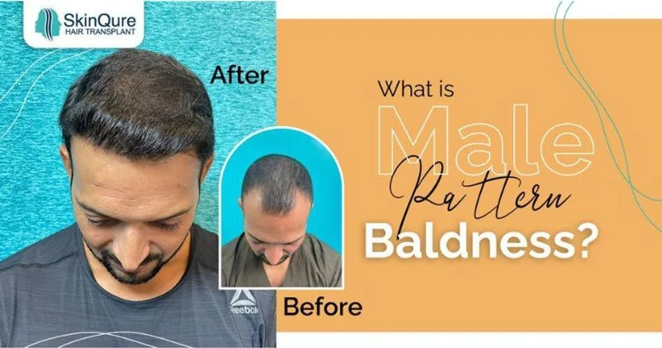 What is male pattern baldness - before and after hair transplant at SkinQure, Delhi