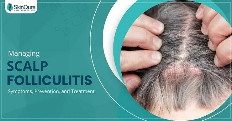 Managing Scalp Folliculitis: Symptoms, Prevention, and Treatment - SkinQure, Delhi