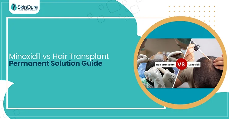 Minoxidil vs Hair Transplant: Permanent Solution Guide - SkinQure, Delhi