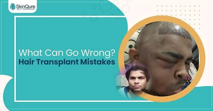 Mistakes That Can Ruin Your Hair Transplant - SkinQure, Delhi