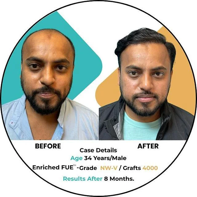Monsoon hair care essentials: A comprehensive guide to healthy hair - SkinQure, Delhi