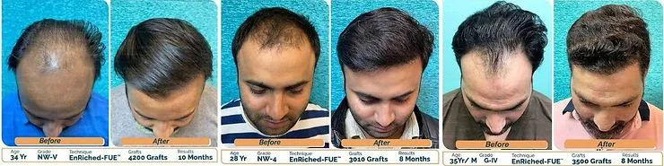Hair Transplant Cost in Delhi: Understanding Factors & Considerations - SkinQure, Delhi