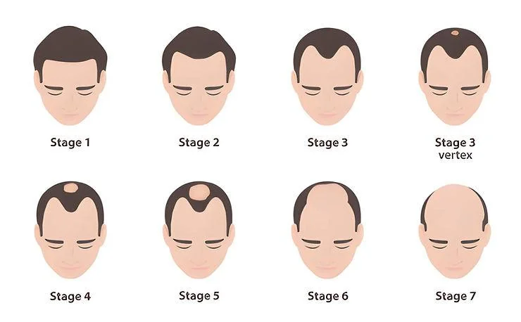 Norwood Scale: 7 Stages of Male Hair Loss - SkinQure, Delhi